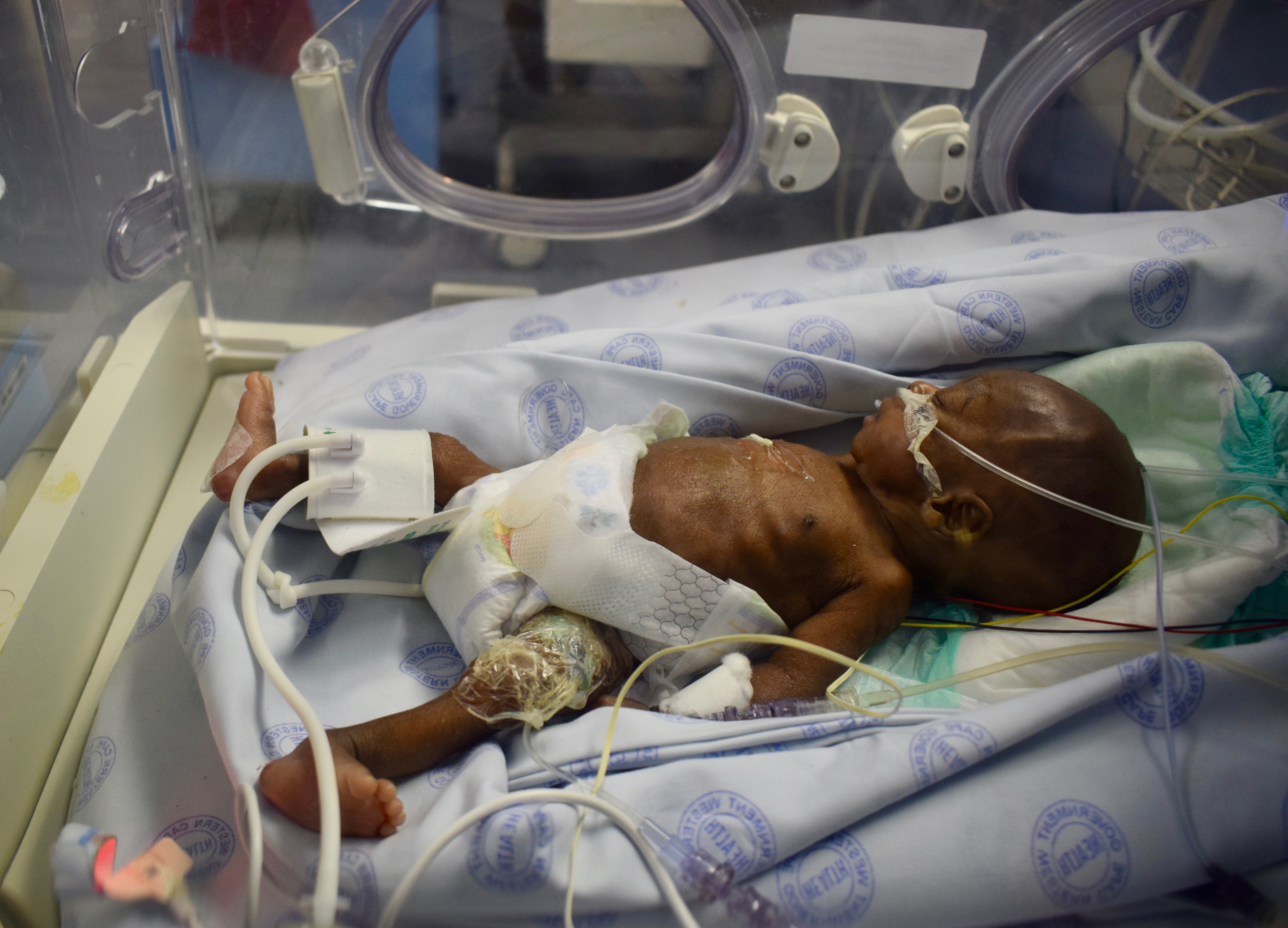 Newborn with neonatal sepsis